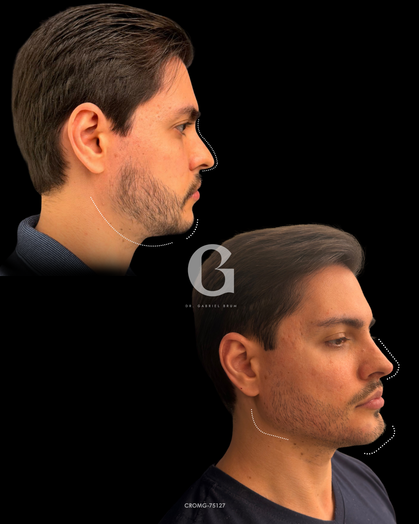 Montagem fornecida com dois registros de perfil do mesmo paciente