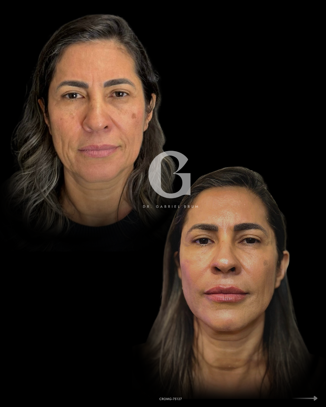 Montagem fornecida com dois registros frontais da mesma paciente