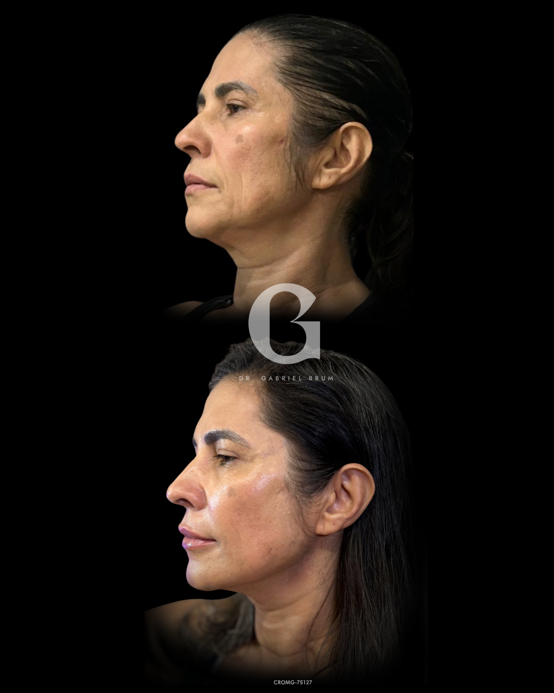 Montagem fornecida com dois registros de perfil da mesma paciente