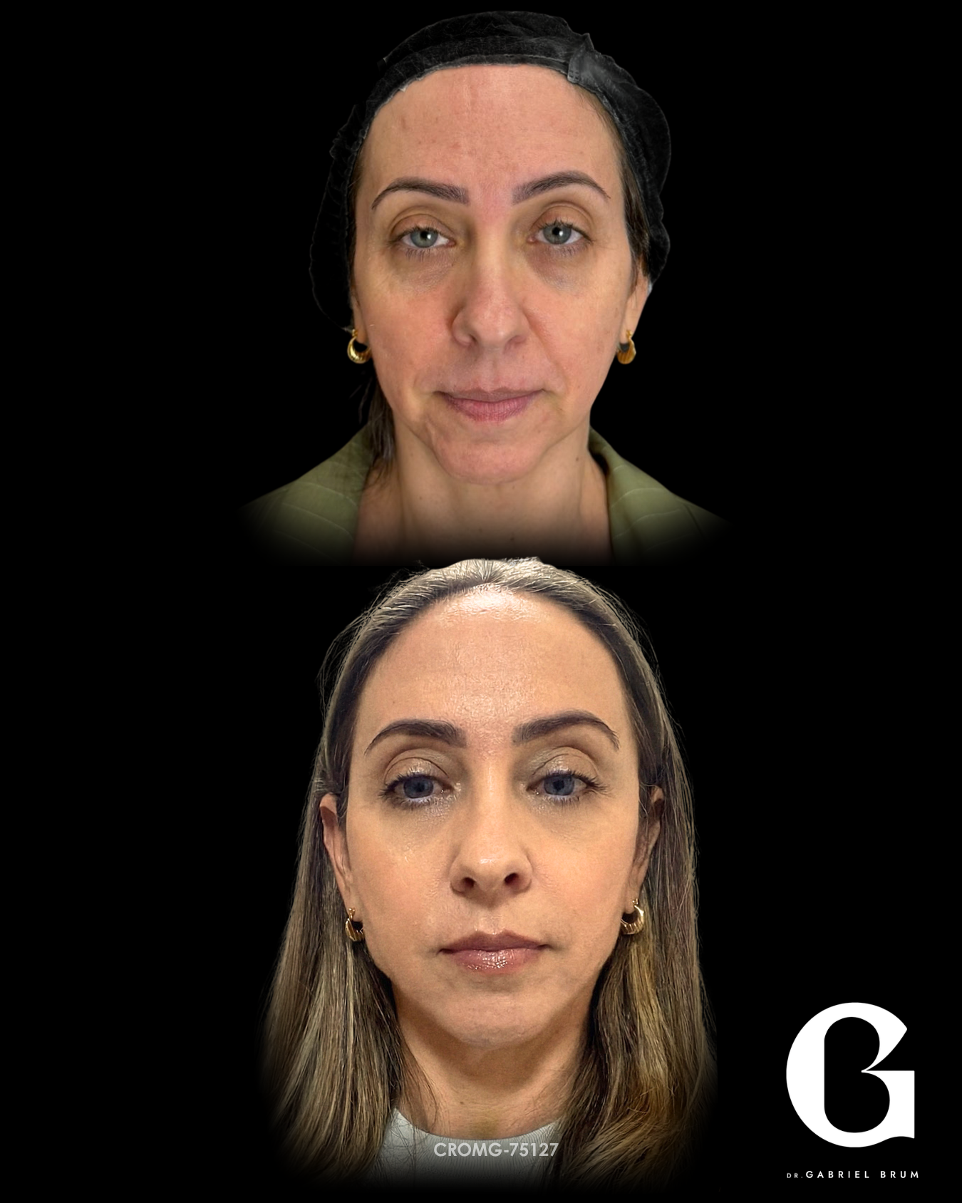 Montagem original fornecida com os registros frontais de antes e depois da mesma paciente