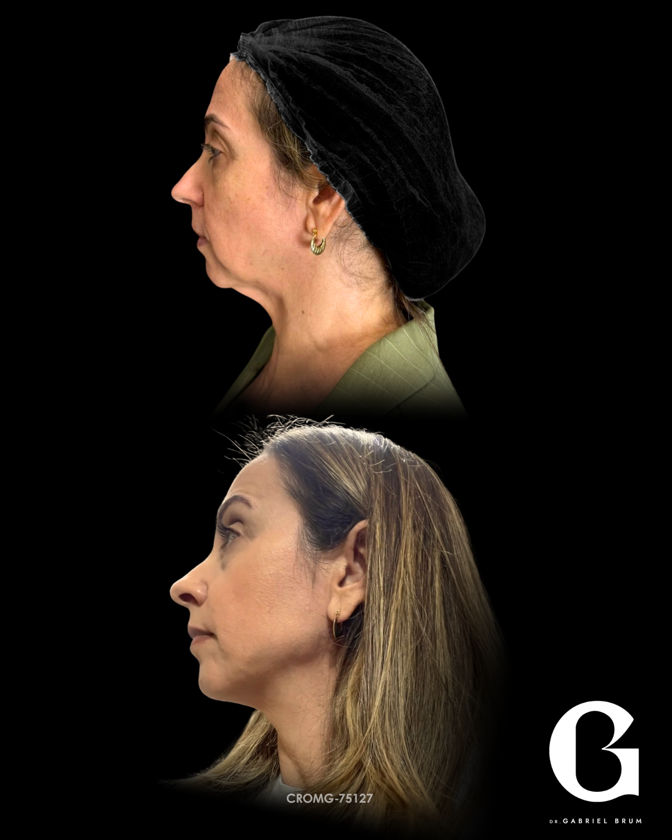 Montagem original fornecida com os registros de perfil de antes e depois da mesma paciente